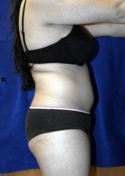 Before Image: Liposuction and Gluteal Augmentation by Fat Grafting - other