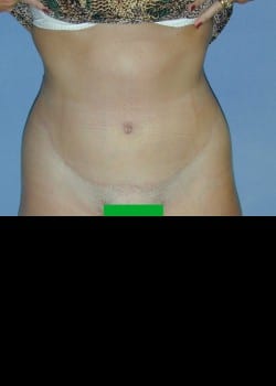 After Image: Extended abdominoplasty with abdomen, flank and side liposuction - front