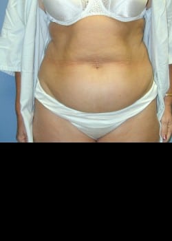 Before Image: Extended abdominoplasty with abdomen, flank and side liposuction - front