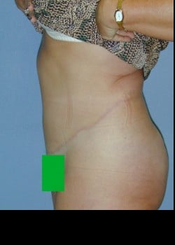 After Image: Extended abdominoplasty with abdomen, flank and side liposuction - other