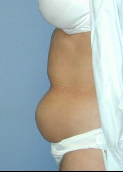 Before Image: Extended abdominoplasty with abdomen, flank and side liposuction - other