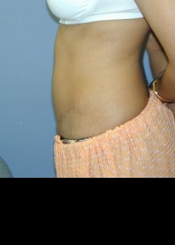 After Image: Abdominoplasty, umbilical hernia repair and rectus diastasis repair - other