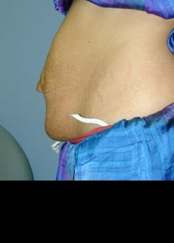Before Image: Abdominoplasty, umbilical hernia repair and rectus diastasis repair - other