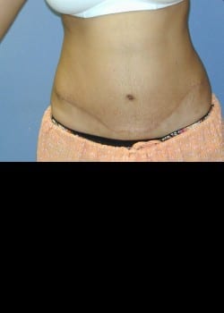 After Image: Abdominoplasty, umbilical hernia repair and rectus diastasis repair - front