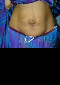 Before Image: Abdominoplasty, umbilical hernia repair and rectus diastasis repair - front