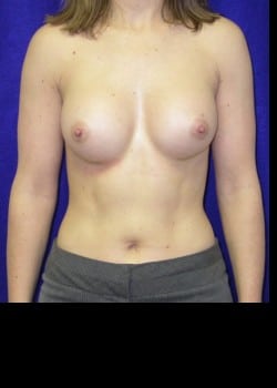 After Image: Breast Augmentation with Saline Breast implants - front