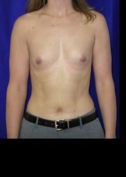 Before Image: Breast Augmentation with Saline Breast implants - front