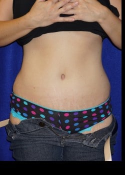 After Image: Abdominoplasty with Large Volume Liposuction of the Flanks and Sides - front