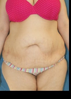 Before Image: Abdominoplasty with Large Volume Liposuction of the Flanks and Sides - front