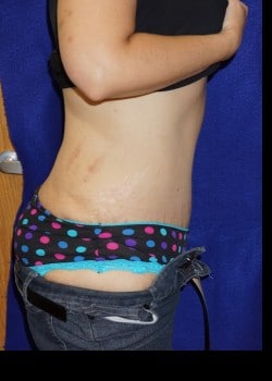 After Image: Abdominoplasty with Large Volume Liposuction of the Flanks and Sides - other