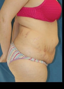 Before Image: Abdominoplasty with Large Volume Liposuction of the Flanks and Sides - other