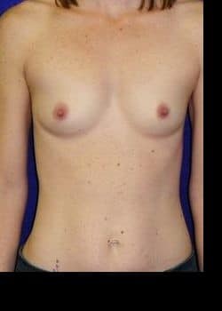 Before Image: Breast Augmentation with Saline Filled Breast Implants - front