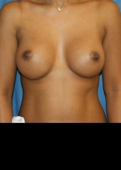 After Image: Breast augment with saline breast implants - front