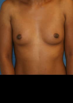 Before Image: Breast augment with saline breast implants - front