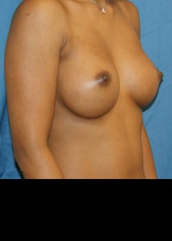 After Image: Breast augment with saline breast implants - other