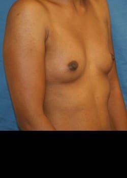 Before Image: Breast augment with saline breast implants - other