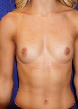 Before Image: Breast augmentation with silicone implants - front
