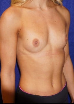 Before Image: Breast augmentation with silicone implants - other