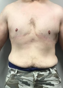 After Image: Gynecomastia Reduction in severe weight loss patient - front