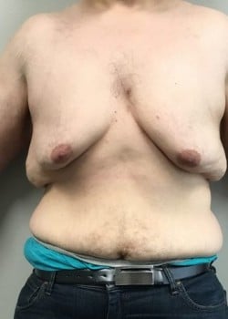 Before Image: Gynecomastia Reduction in severe weight loss patient - front