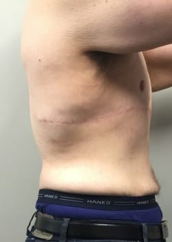 After Image: Gynecomastia Reduction in severe weight loss patient - front