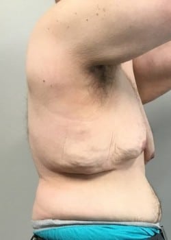 Before Image: Gynecomastia Reduction in severe weight loss patient - front