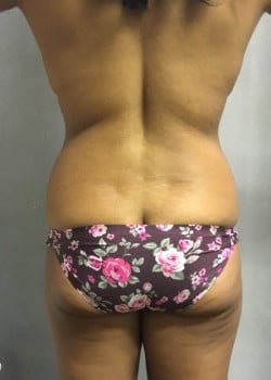 Before Image: Liposuction of Flanks and Hips - back