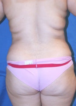Before Image: Liposuction of sides and flanks - back