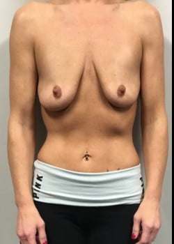 Before Image: Breast augmentation with silicone breast implants and full breast lift - front