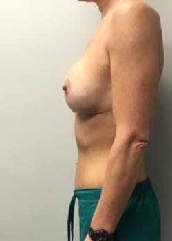 After Image: Breast augmentation with silicone breast implants and full breast lift - other