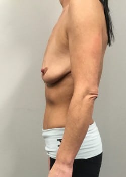 Before Image: Breast augmentation with silicone breast implants and full breast lift - other