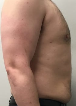 After Image: Gynecomastia Reduction - front