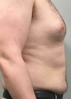 Before Image: Gynecomastia Reduction - front