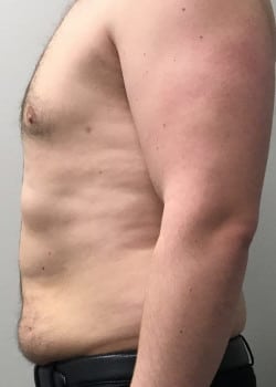 After Image: Gynecomastia Reduction - front