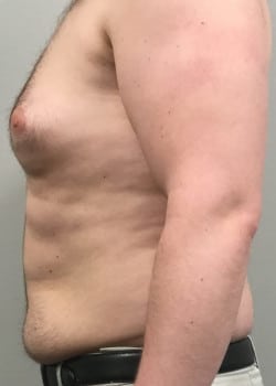 Before Image: Gynecomastia Reduction - front