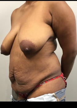 Before Image: Mommy makeover with full tummy tuck, liposuction and breast lift - other