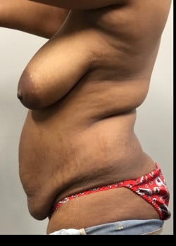 Before Image: Mommy makeover with full tummy tuck, liposuction and breast lift - other