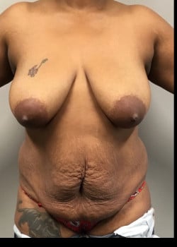 Before Image: Mommy makeover with full tummy tuck, liposuction and breast lift - front
