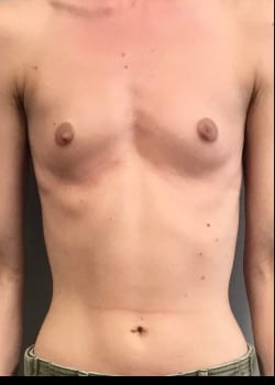 Before Image: Breast Augmentation with IDEAL saline filled  breast implants - front