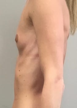 Before Image: Breast Augmentation with IDEAL saline filled  breast implants - other