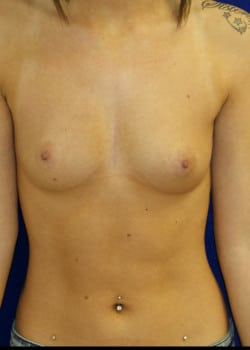 Before Image: Breast Augmentation with Saline Breast Implants - front