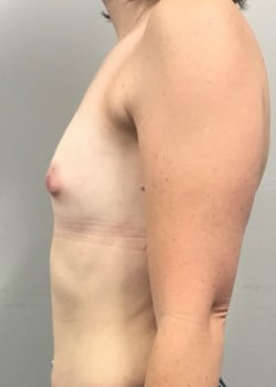 Before Image: Breast Augmentation with Silicone Breast Implants - other