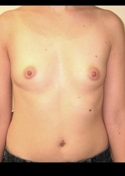 Before Image: Breast Augmentation with saline breast implants - front