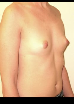 Before Image: Breast Augmentation with saline breast implants - other