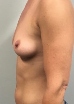 Before Image: Breast Augmentation with IDEAL Breast Implants - other
