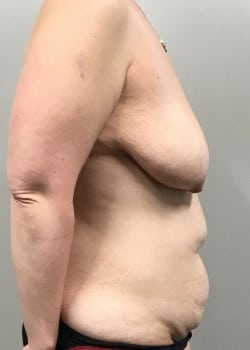 Before Image: Mommy Makeover with tummy tuck,liposuction, breast lift and breast augmentation with saline breast implants - other