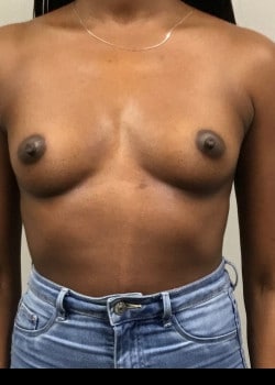 Before Image: Breast Augmentation with IDEAL saline breast implants - front