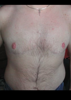 After Image: FtM top surgery double incision (DI) with nipple grafts - front