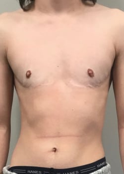 After Image: FtM top surgery double incision (DI) with nipple grafts - front