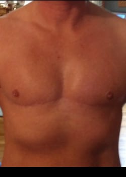 After Image: FtM double incision mastectomy (DI) with nipple grafts for gender confirmation - front